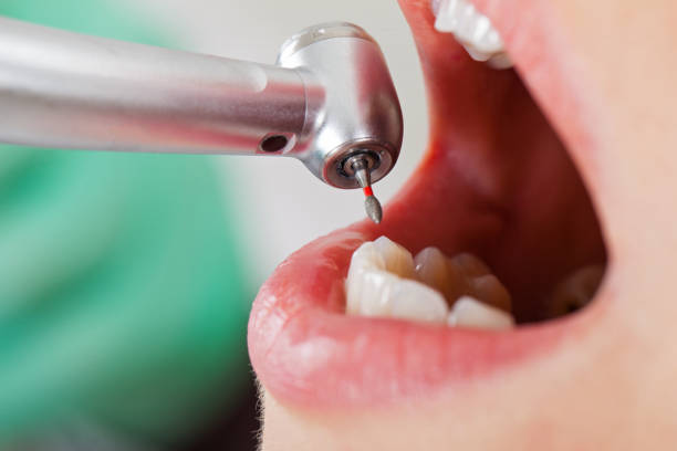 Best Emergency Wisdom Teeth Removal in Cavalero, WA